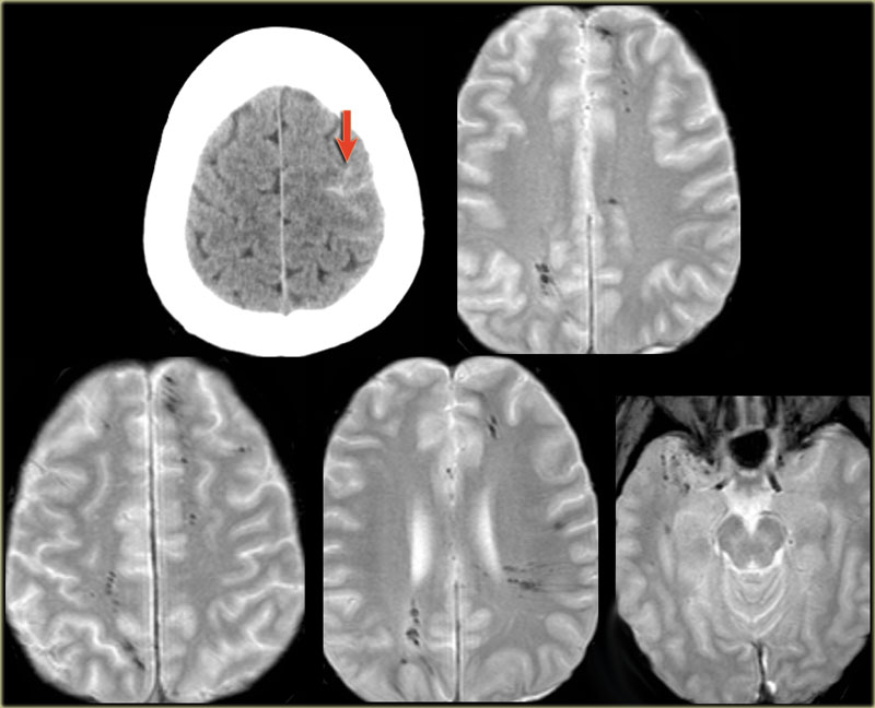 Diffuse axonal injury