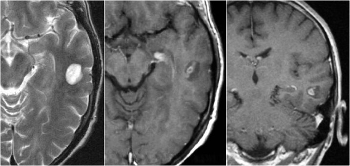 Ganglioglioma. T2WI and CE-T1WI