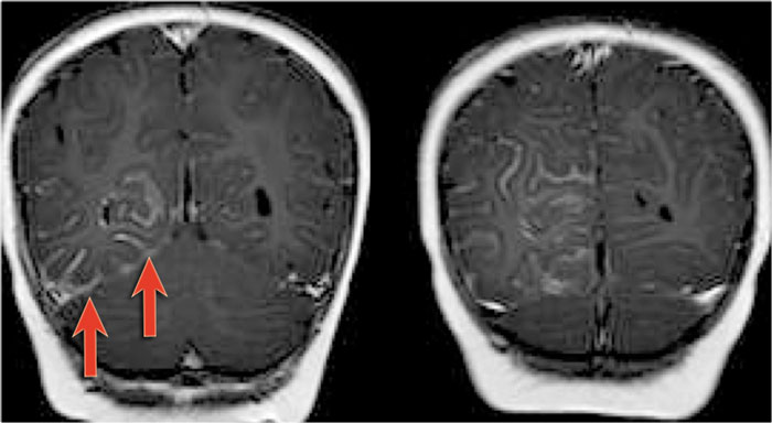 Sturge-Weber angiomatosis. CE-T1WI. Courtesy of Alessandra D' Amico