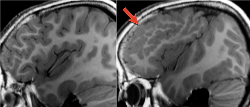 LEFT: normal RIGHT: polymicrogyria (arrow)