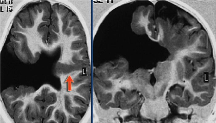 Schizencephaly. Courtesy of Alessandra D' Amico