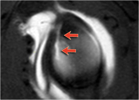 Bankart lesion with superior extention