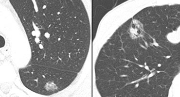 LEFT: 1 in 5 malignantRIGHT: 2 in 3 malignant