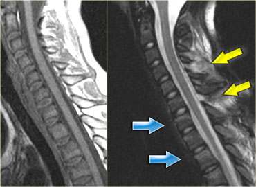 Hyperflexion sprain without fracture