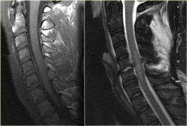 Hyperflexion sprain with spinal cord injury