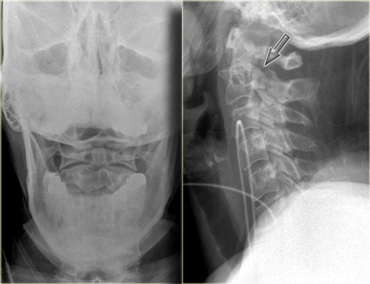 Hangman' s fracture type I