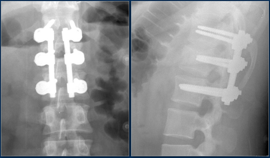 The Radiology Assistant : TLICS Classification Of Fractures