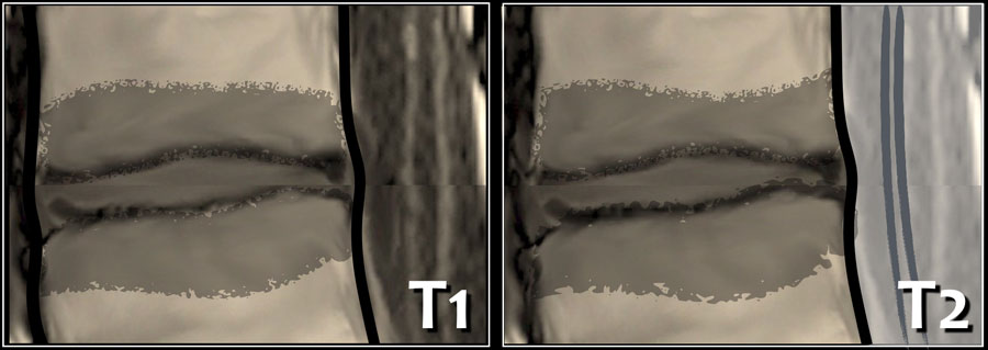 The Radiology Assistant : Lumbar Disc Nomenclature 2.0