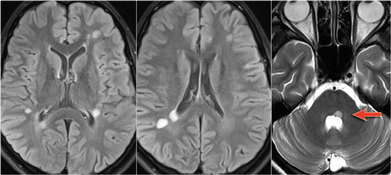 Typical MS in the brain