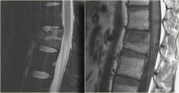 Sagittal T2WI and T1WI