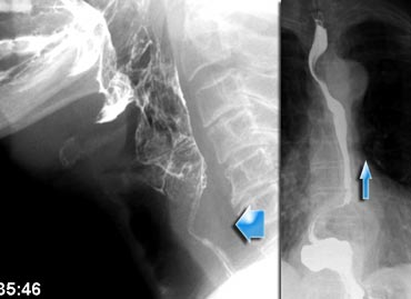 Cricopharyngeal hypertrophy in a patient with reflux.