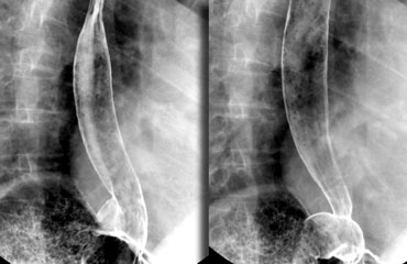 Optimal views of gastro-esophageal junction when air regurgitates from the stomach into the coated esophagus in a patient with a sliding hiatus hernia. 