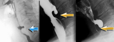 The Radiology Assistant : Swallowing Disorders Update