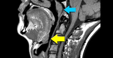 The Radiology Assistant : Swallowing Disorders Update