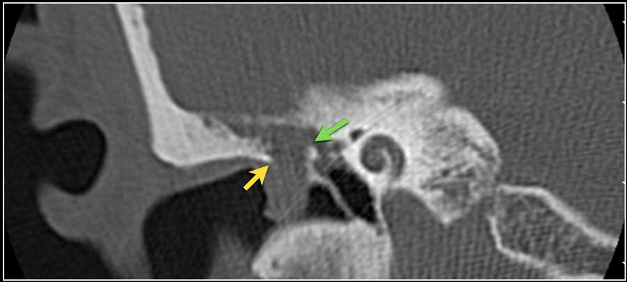 Erosion of scutum in a patient with a cholesteatoma. Also erosion of body of incus.