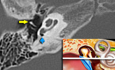 Malleus (yellow arow). Round window (blue arrow)