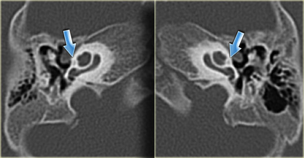 Bilateral cochlear cleft presents as a line-like lucency lateral to the cochlear apex. (arrows)