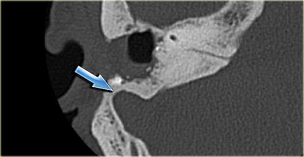 Bulging sigmoid sinus