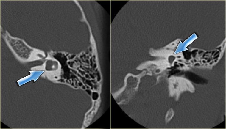 Malformed lateral semicircular canal