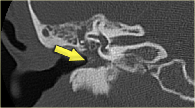 Chronic otitis media