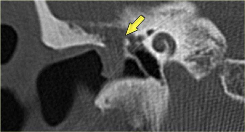 Cholesteatoma of the right ear with destruction of body of the incus and the scutum