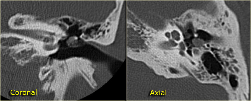 Cholesteatoma