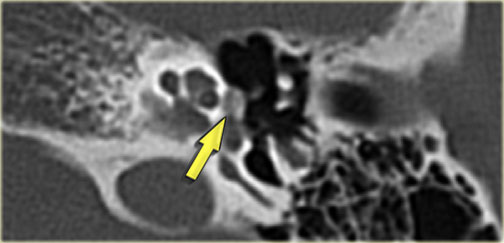 Otosclerosis