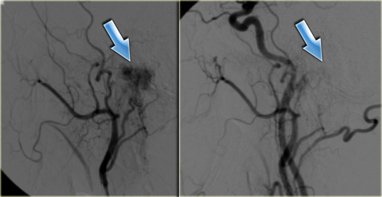 Glomus tumor before and after embolization