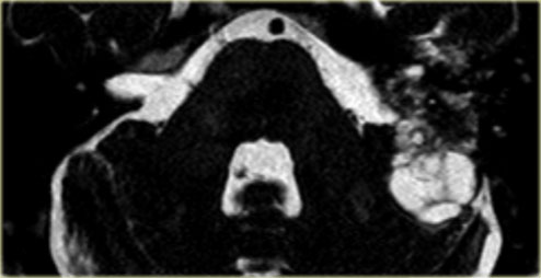 EndoLymphatic Sac Tumor: T2WI