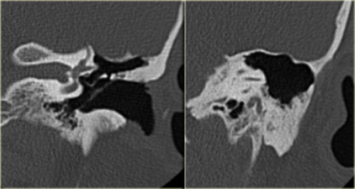 Attico-antrotomy