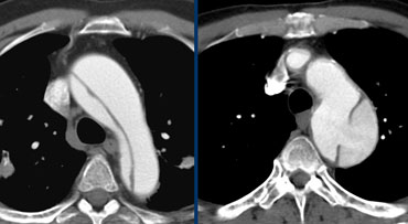 LEFT: Type A dissection with clear intimaflap seen within the aortic arch.RIGHT: Type B dissection. Entry point distal to left subclavian artery.