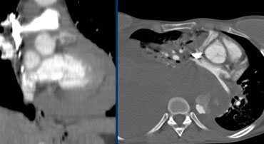 Left: pericardial fluid / hematoma indicates rupture of the dissected aorta. Even small amounts are proving rupture, though hematoma can be extensive such as in this case.Right: Massive hematoma caused by rupture of the dissected aorta into the mediastinum and pleural cavity, no pericaldial hematoma.