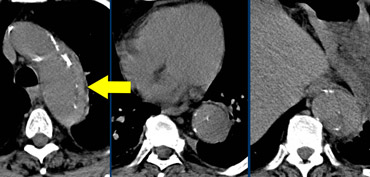 Classic example of IMH. Hyperdense hematoma on NECT. Intima calcifications surround  the true lumen.