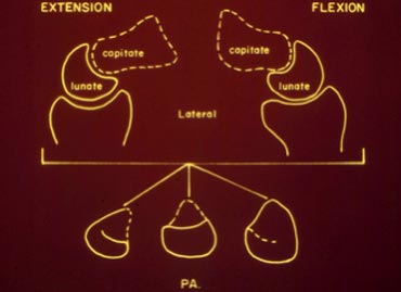 Schematic representation of the lunate shape in different positions