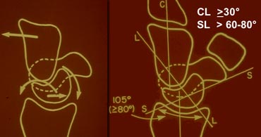 LEFT: Dorsal tilting of the lunate in DISIRIGHT:  Scapholunate angle is > 80?