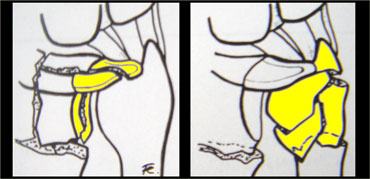 Intraarticular fracture of sigmoid notch or ulnar headModified and reprinted with permission from reference (9)