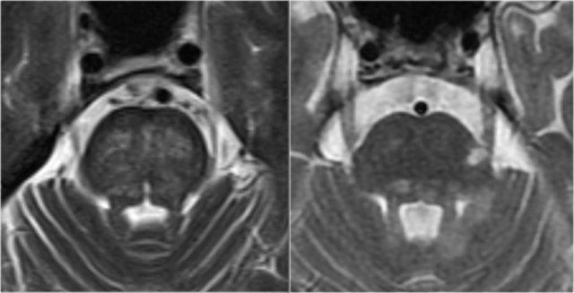 Brainstem involvement in small vessel disease (left). Focal brainstem lesions in MS (right).