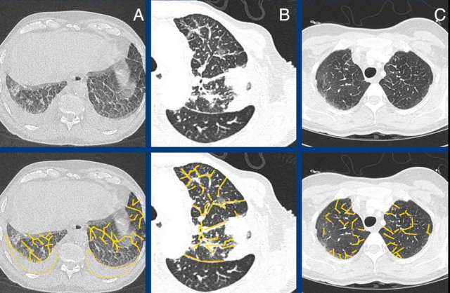 Pulmonary edema (A), Lymphangitic carcinomatosa (B), EGPA (C).