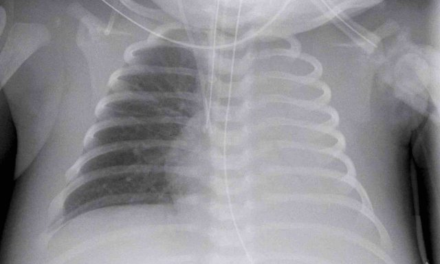 Complete atelectasis of the left lung