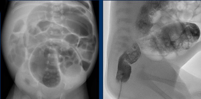 Typical case of Hirschsprung disease involving the rectum (short segment disease).