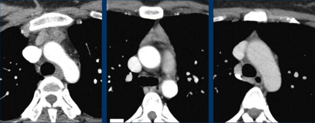 Normal involution of the thymus at age 14, 18 and 24