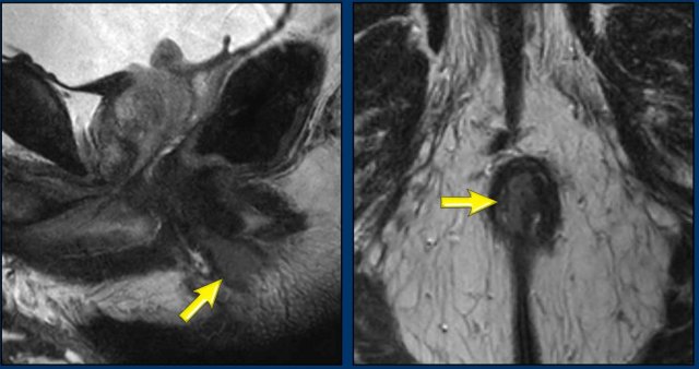Anal tumor in the middle and lower third of the anal canal before treatment.