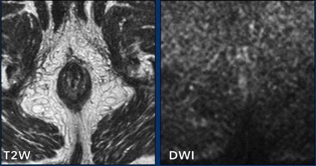 No residual tumor 6 months post chemoradiation.
