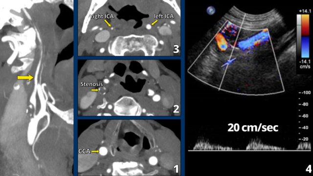 Click on image for an enlarged view. Small distal caliber of the distal ICA and a drop in systolic peak velocity.