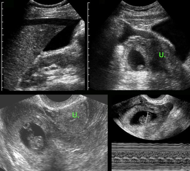 Ectopic pregnancy with living fetus.