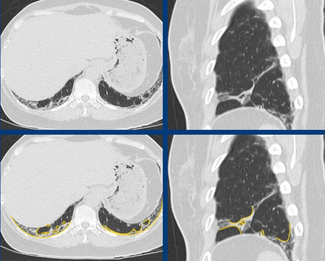 ibrotic NSIP in anti-synthetase syndrome