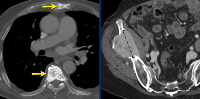 Left: non-measurable metastasis.  Right: measurable metastasis.