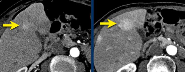 LEFT: Hyperenhancing observation detected in segment 5. RIGHT: follow up 3 months later shows growth.