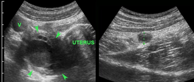Acute appendicitis and right ovarian cyst. (v= iliac vein)