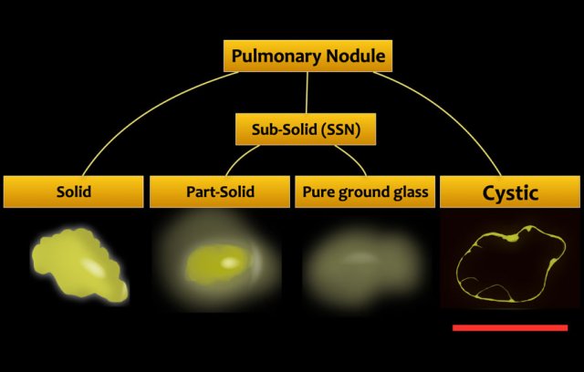 CT imaging morphology of pulmonary nodules.